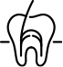 根管治療